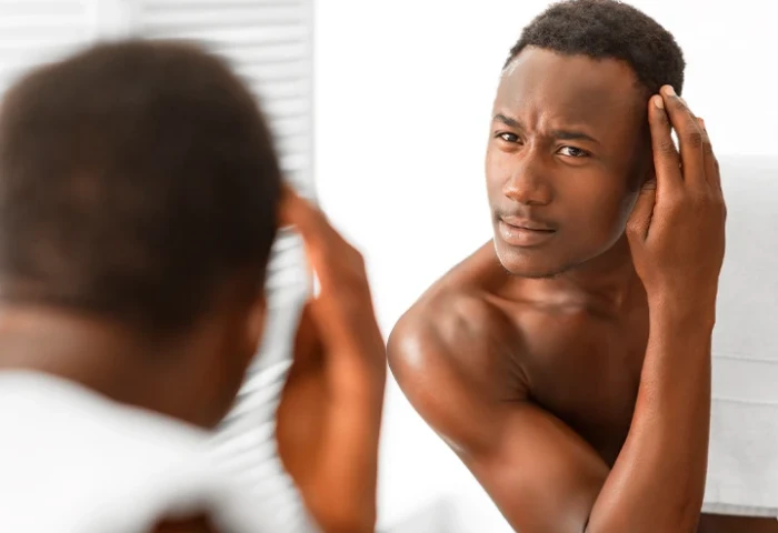 3 sinais de que você está ficando calvo e não percebeu