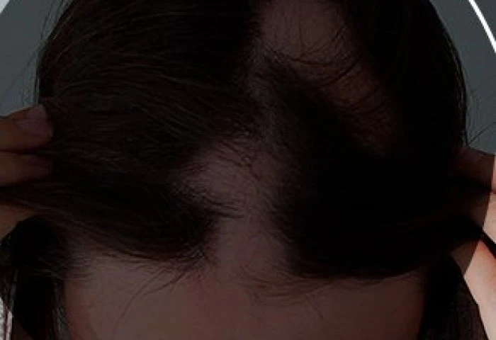 Alopecia feminina no tapete vermelho