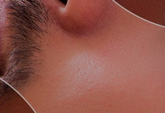 Pode usar pelo de barba no transplante capilar? Como funciona?