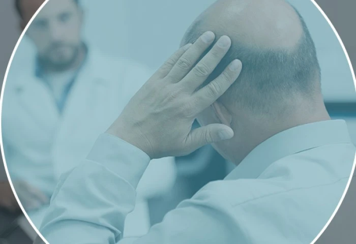 Quando começar a usar a Finasterida para tratar a calvície