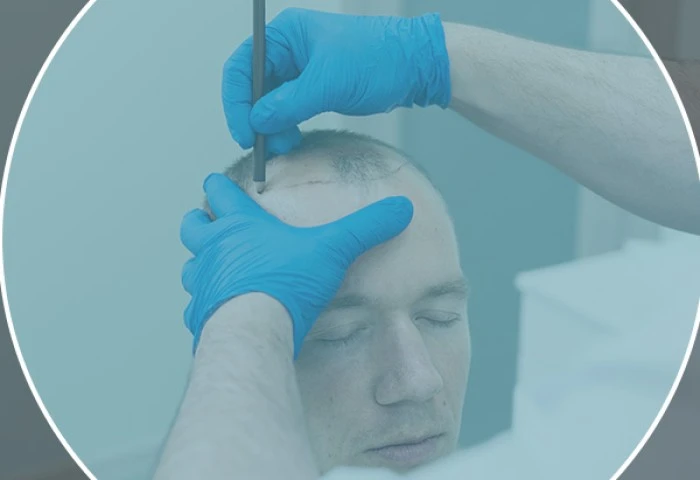 Qual o custo de um transplante capilar?