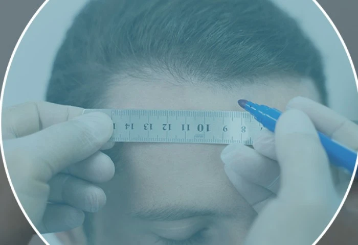 Como escolher a melhor clínica no Brasil para transplante capilar