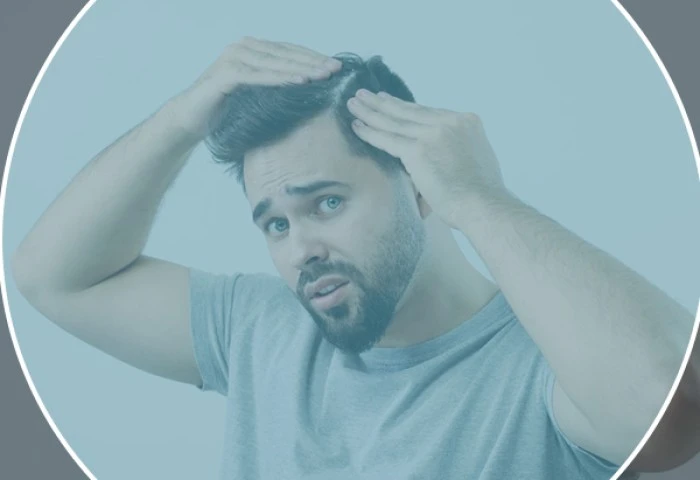 Tenho apenas entradas: O transplante capilar ainda vale a pena?