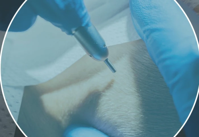 Body Hair: Como ampliar as possibilidades de transplante capilar para quem tem área doa...