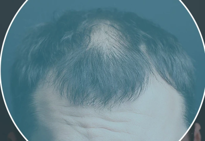 Calvície avançada? O Transplante Capilar pode ser a solução