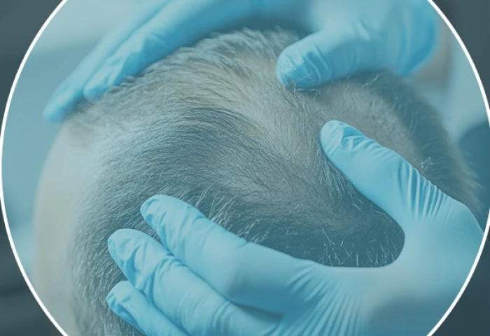 Transplante Capilar ICB: Naturalidade e planejamento individualizado para cada procedim...